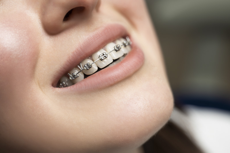 Woman wearing braces for teeth correction