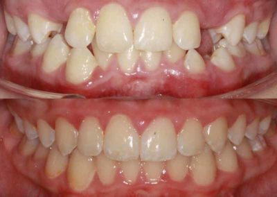 Teeth correction by Scott Family Orthodontics