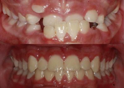 Patient teeth correction by Scott Family Orthodontics