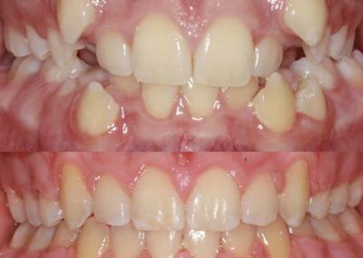 Orthodontic treatment by Scott Family Orthodontics